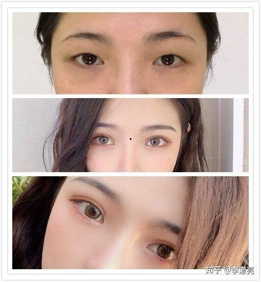 明星割双眼皮去哪里,揭秘热门整形医院与专家选择